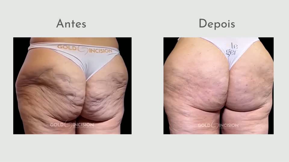 Miniatura do vídeo: Passo a passo do antes e depois