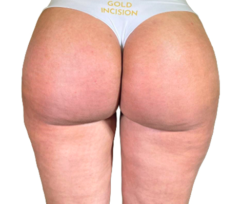 Resultado de paciente tratada com o método GoldIncision — depois